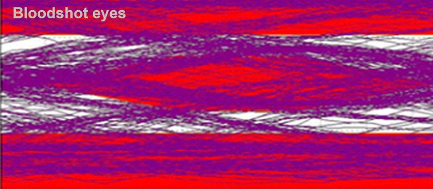 Bloodshot eyes